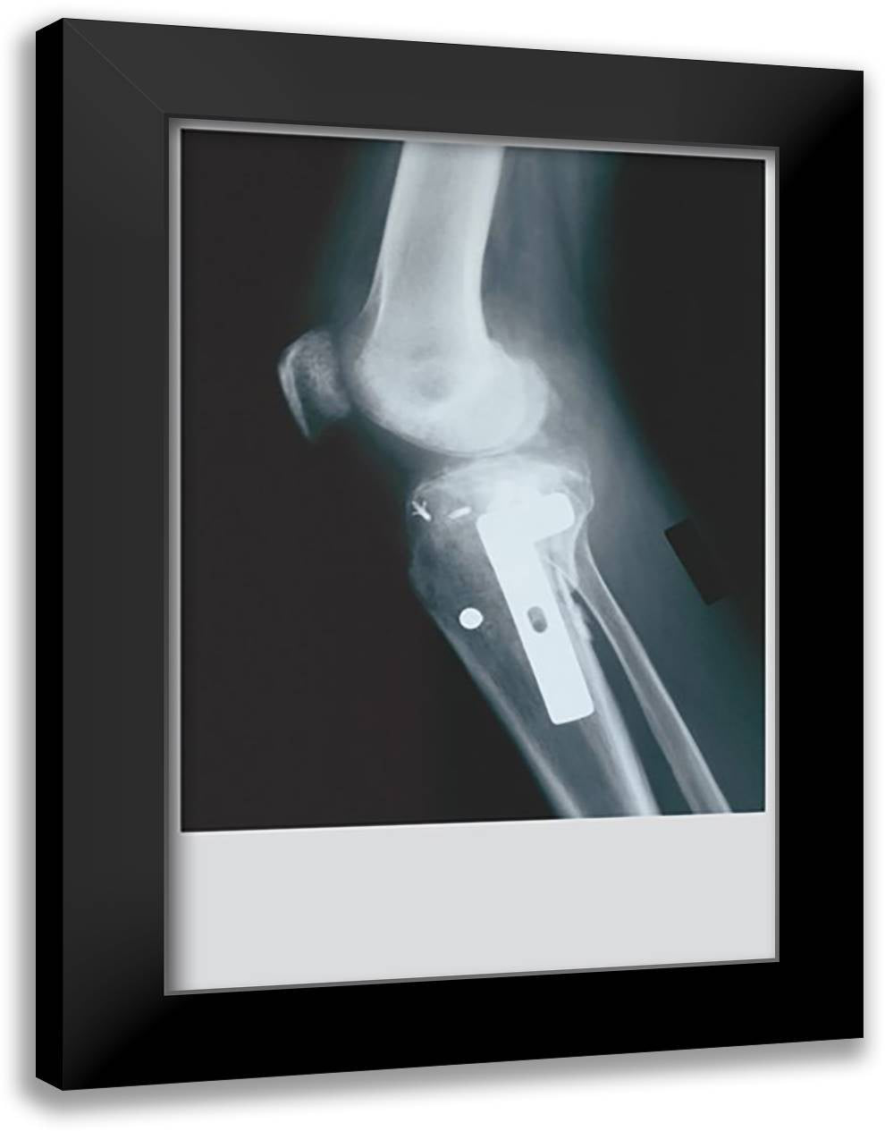 Knee Replacement 16x22 Black Modern Wood Framed Art Print Poster