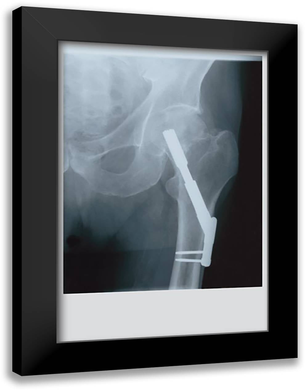 Fixed Femur 16x22 Black Modern Wood Framed Art Print Poster