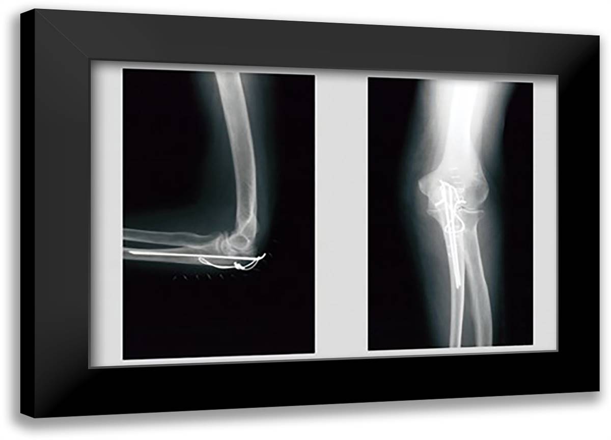 Shattered Elbow Repair 22x16 Black Modern Wood Framed Art Print Poster