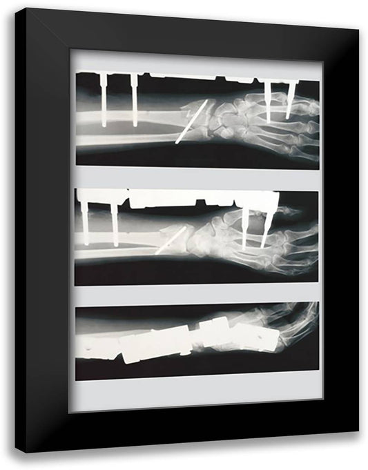 Arm with External Fixation 16x22 Black Modern Wood Framed Art Print Poster