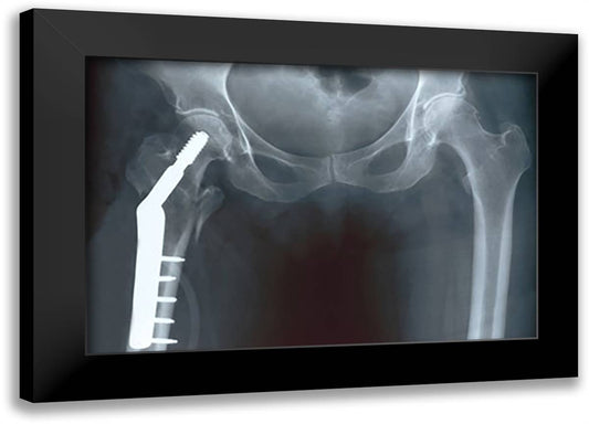 Femur Repair 22x16 Black Modern Wood Framed Art Print Poster