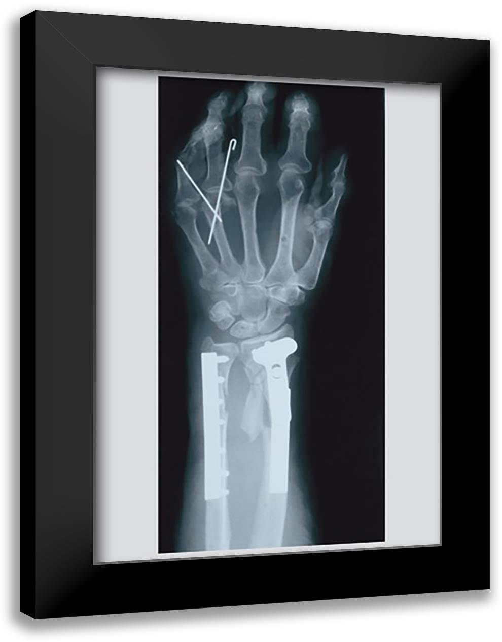 Arm and Finger Repair 16x22 Black Modern Wood Framed Art Print Poster